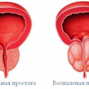 Prostata zánět (prostatitis)