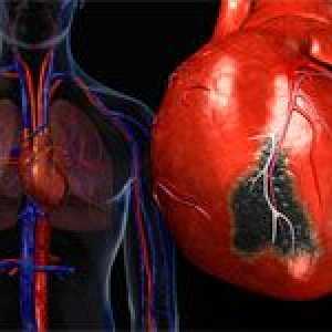 Možné příznaky infarktu myokardu