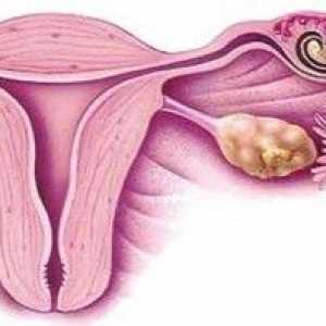 Identifikace raných fázích mimoděložního těhotenství: příznaky a stanovení diagnózy.