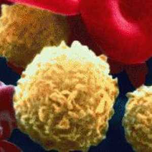 Vysoký krevní leukocyty