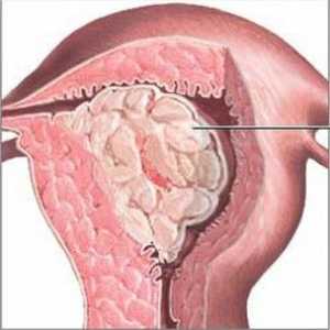Žlázy hyperplazie endometria: příčiny, formy a fáze léčby